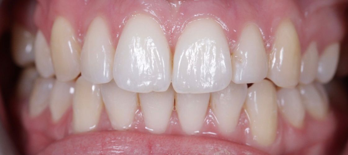 garforth dental - Invisalign Leeds