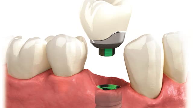 Andy Berwick Dental Implants at No.4 Dental Studio - Dentists in ripon