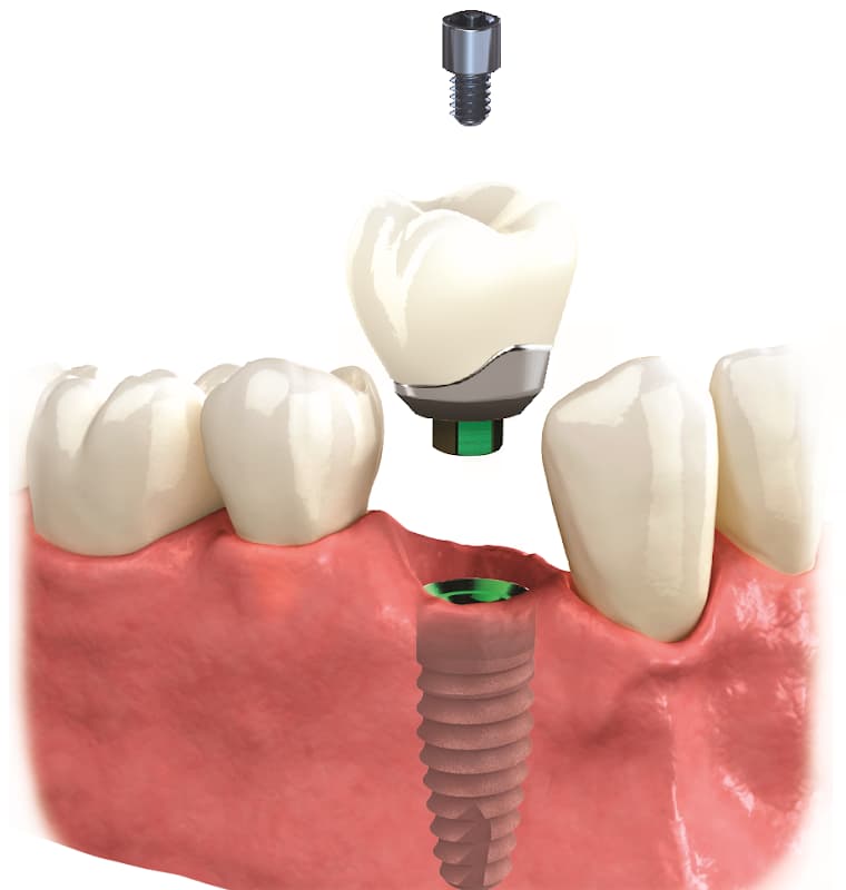 Andy Berwick Dental Implants at No.4 Dental Studio