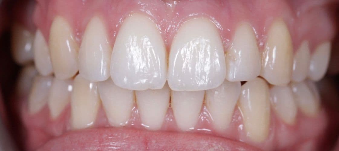 garforth dental - Invisalign Leeds